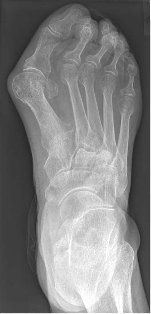 Hallux valgus · RTG prikaz stopala